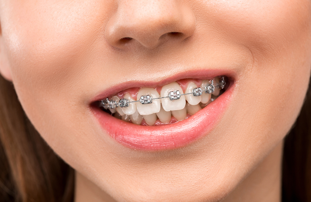 aparat-dentar-fix-metalic