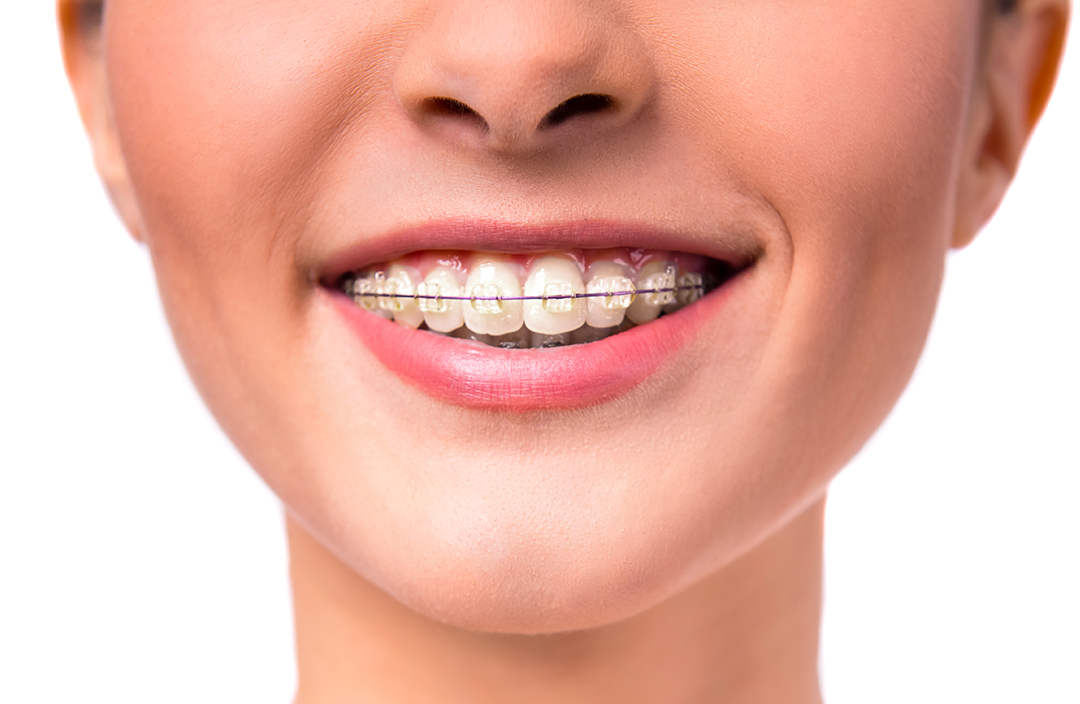 aparat-dentar-fix-safir