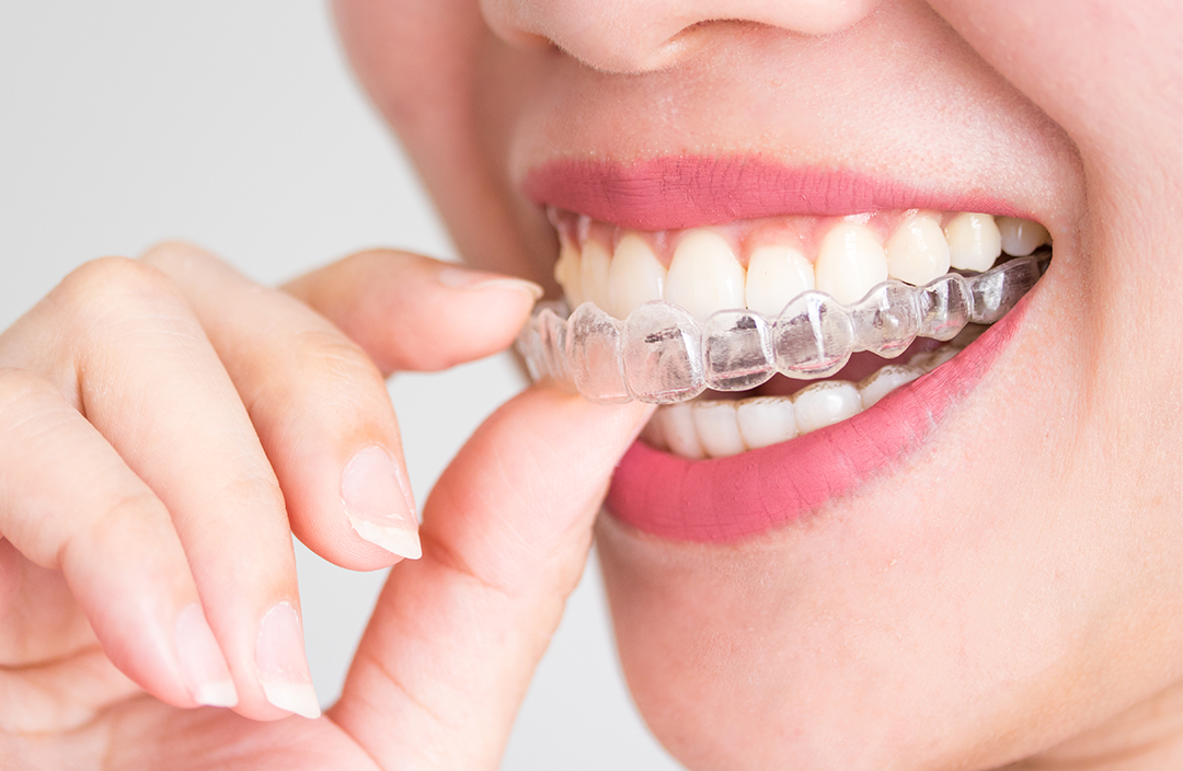 aparat-dentar-invizibil
