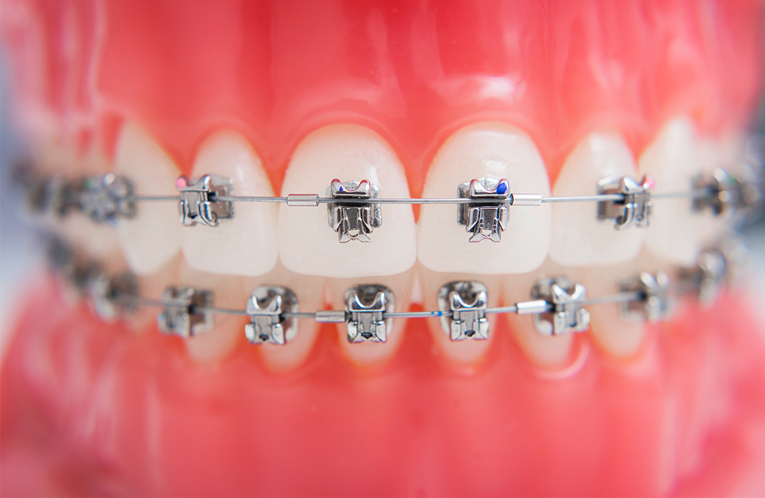 aparate-dentare-fixe
