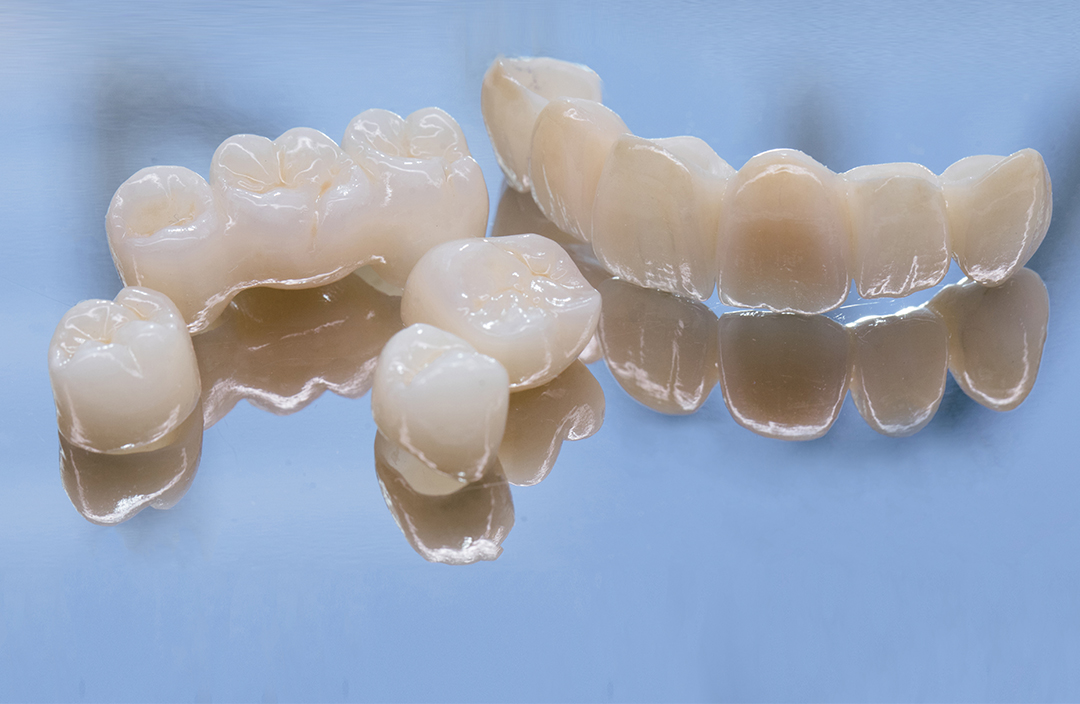 coroane-dentare-2