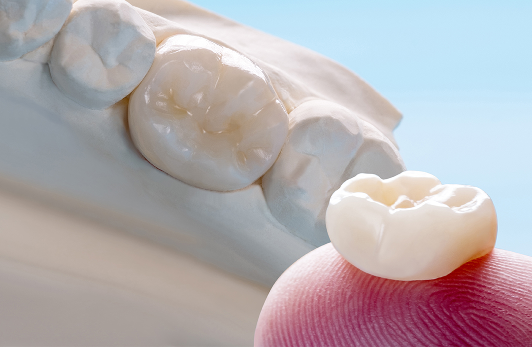 coroane-dentare-3