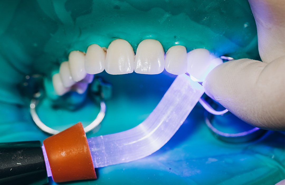 coroane-dentare-4