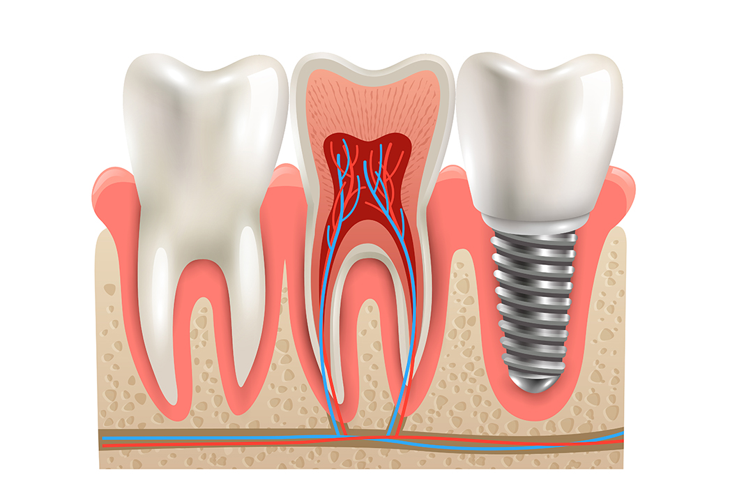implant-dentar-1