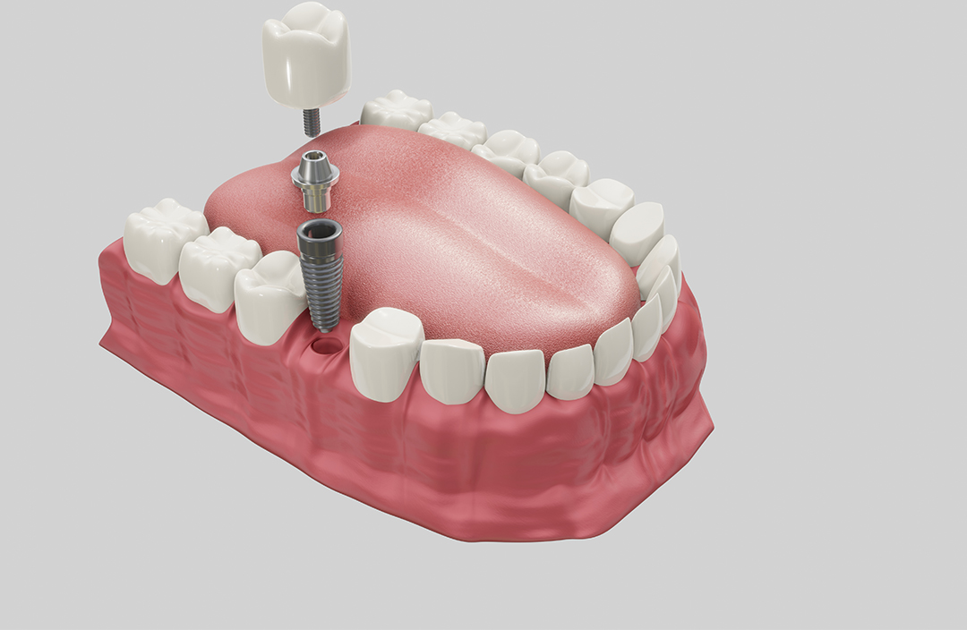 implant-dentar-2
