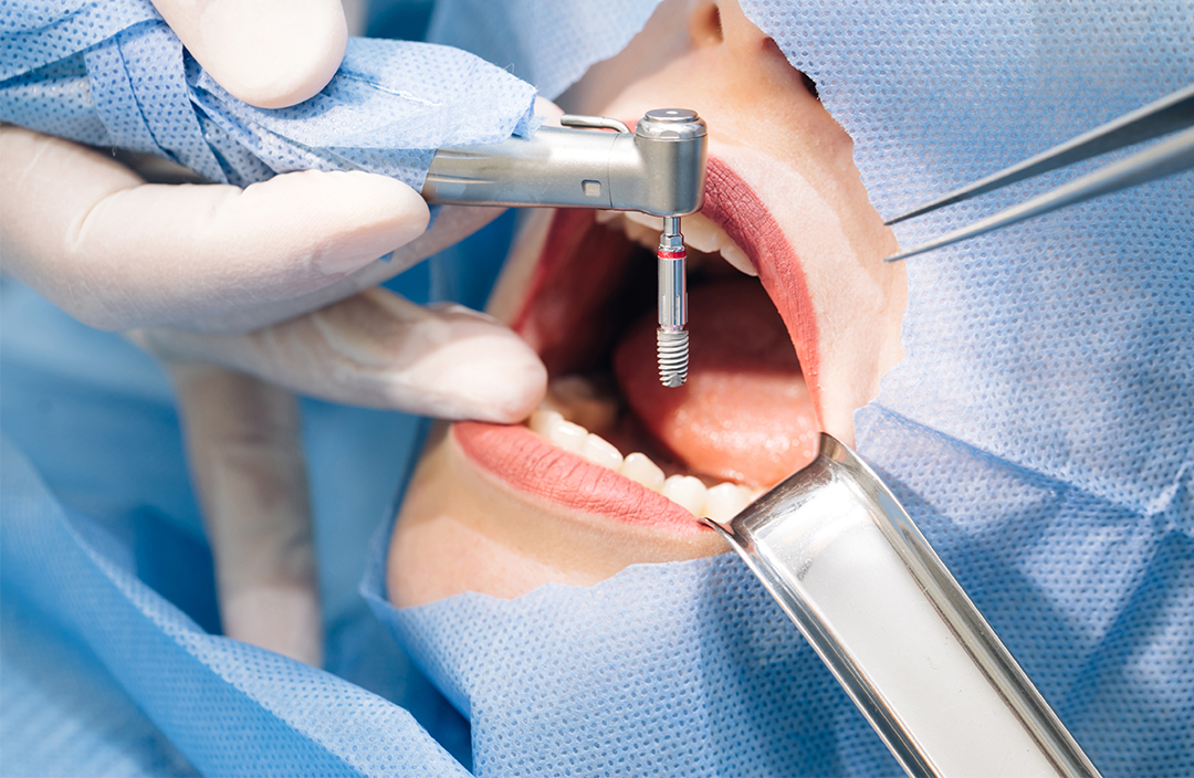 implant-dentar-3