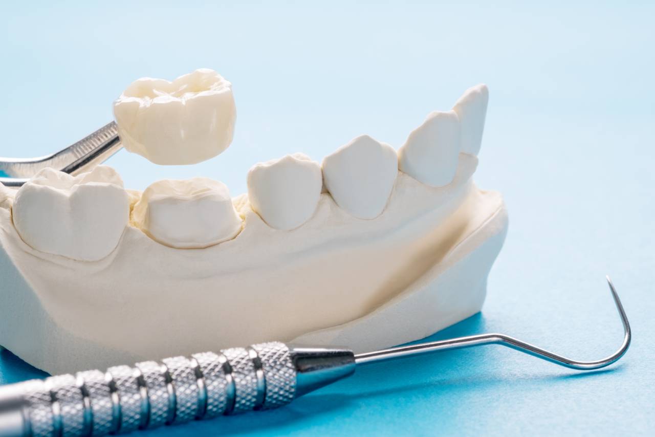 coroana-dentara-dentplus