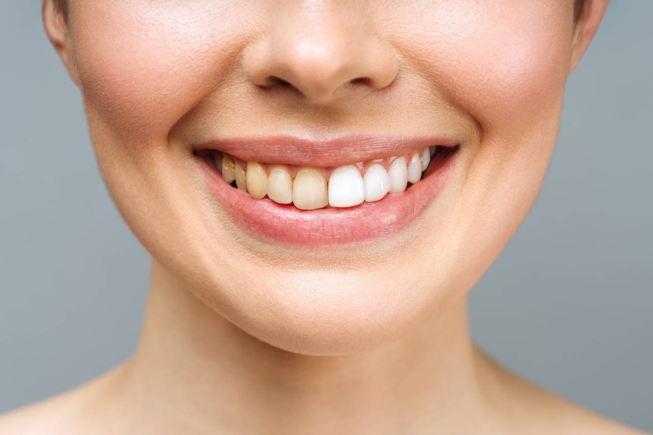 detartraj_dentplus