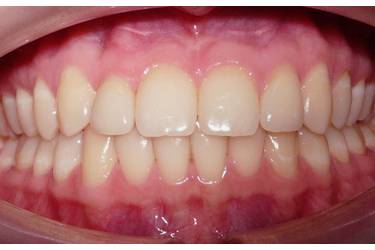 Dental Implants Pacient - After