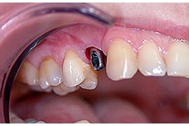 Dental Implants Pacient - Before