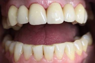 Dental Implants Pacient - After