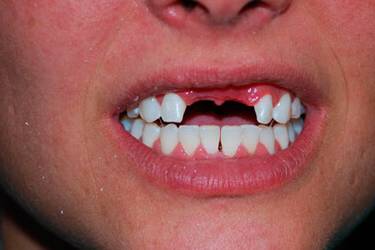 Dental Implants Pacient - Before