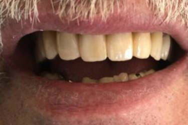 Dental Implants Pacient - After