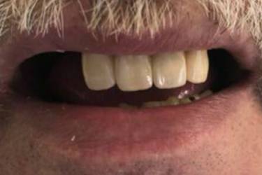 Dental Implants Pacient - Before