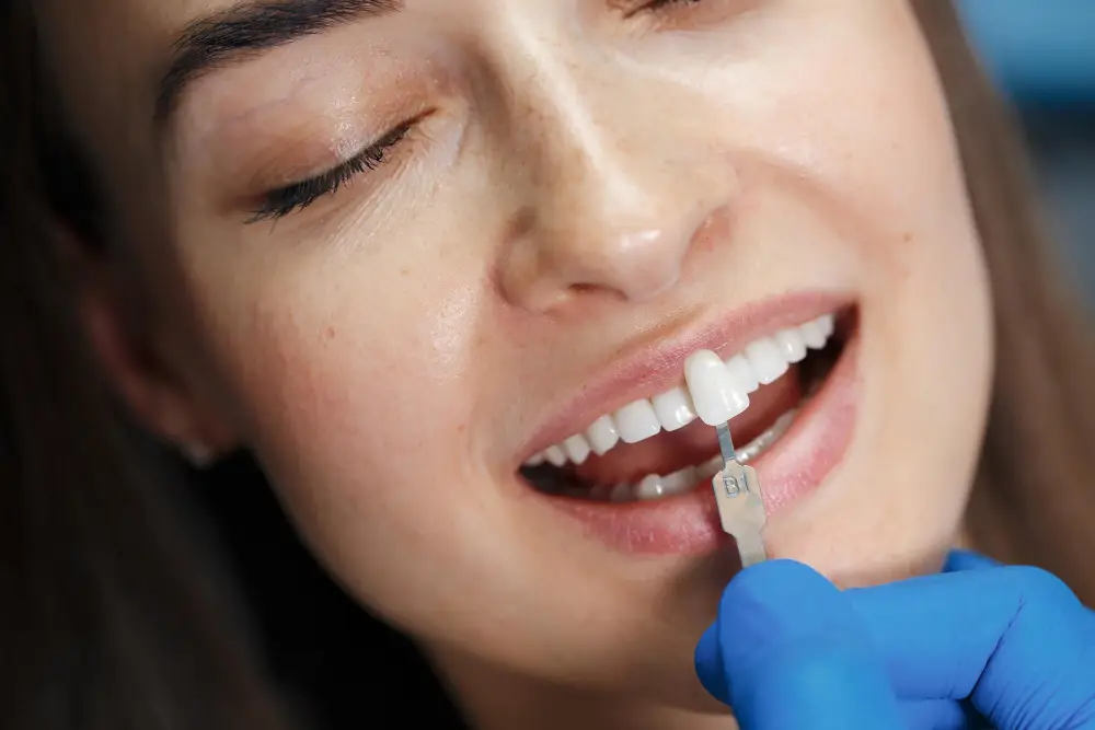 dental-veneers