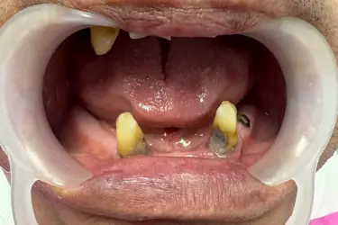 All-on-4 and All on 6 Dental Implants - Before