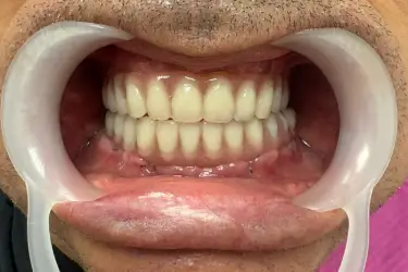 All-on-4 and All on 6 Dental Implants - After