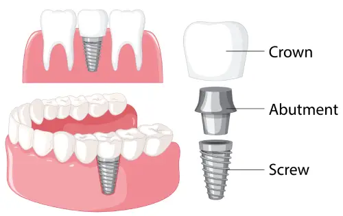 Dental Implants London